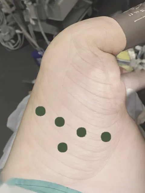 Tórax de paciente em posição lateral com as cinco pequenas incisões da cirurgia robótica marcadas
